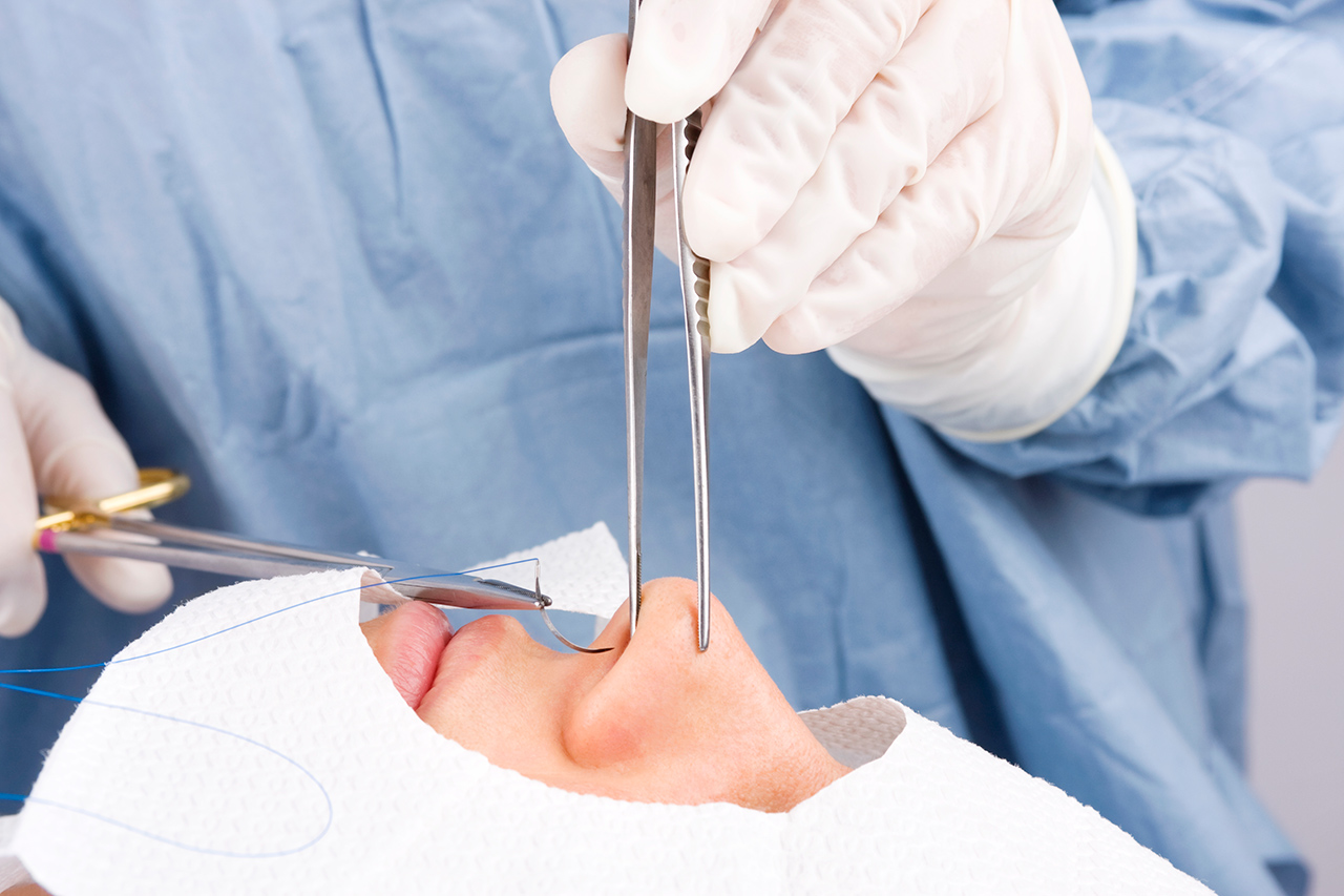 Perfil De Cirurgia De Desvio De Septo Desvio De Septo O Que é,